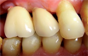 歯間　歯周病