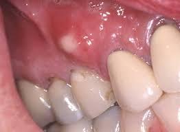 歯茎の膿