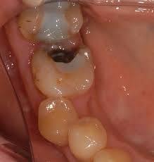 虫歯穴　歯周病